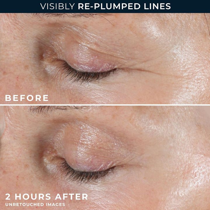 Retinol Correxion Deep Wrinkle Non-Invasive Targeted Patches with Hyaluronic Acid + Firming Peptides for Forehead, 11 Lines, Crow’S Feet and Laugh Lines, (6 Patches) with Retinol Eye Packette