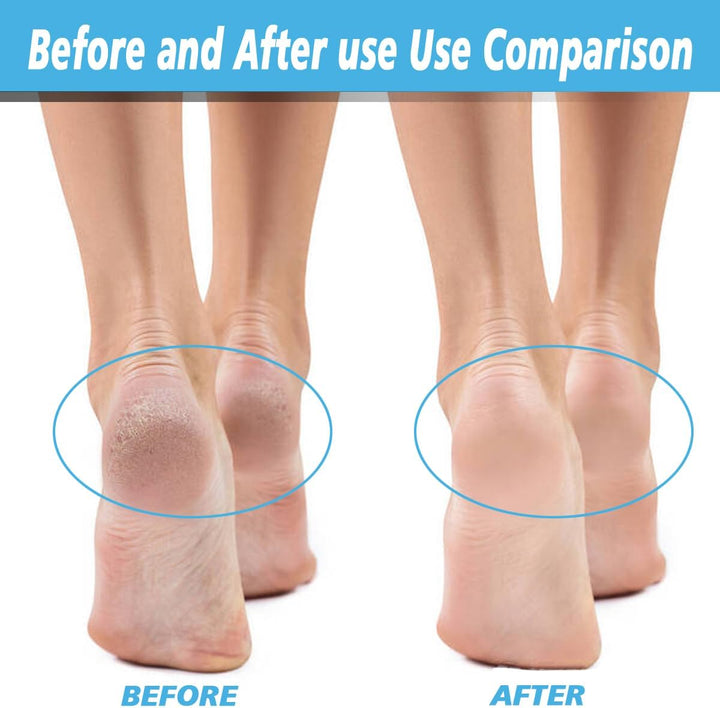 12 Pack Replacement Roller for Flawless Pedi, Replacement Head Refills Compatible with Finish Touch Flawless Pedi Electronic Tool File,6 Extra Coarse & 6 Regular Coarse