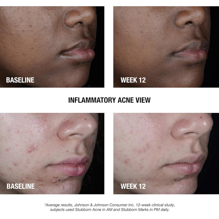 Stubborn Acne AM Face Treatment with 2.5% Micronized Benzoyl Peroxide Acne Medication, Oil-Free Daily Facial Treatment Reduces Size & Redness of Breakouts, Paraben-Free, 2.0 Oz