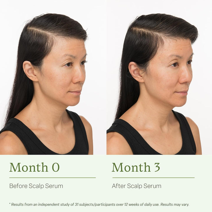Scalp Serum for Thinning Hair Clinically Tested, Non-Greasy Formula with Amino Acids, Caffeine & Rosemary Oil Promotes Healthy Scalp & Fuller-Looking Hair, Reduces Oil & Product Buildup