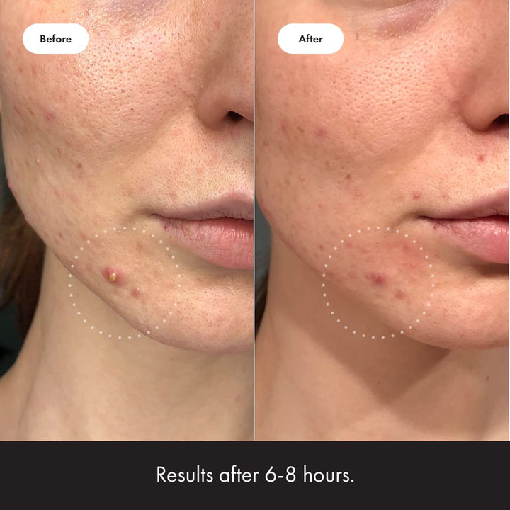 ™ Invisible+ Patch - Daytime Hydrocolloid Acne Pimple Patches for Covering Zits and Blemishes, Ultra Thin Spot Stickers for Face and Skin (24 Medium and 15 Small Patches)