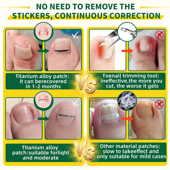 Large Size-Titanium Alloy Ingrown Toenail Treatment & Removal Kit for Quick Relief, Ingrown Toenail Removal Kit， Professional Ingrown Toenail Corrector, Ingrown Toenail Tools for Quick Relief, 10 Pcs