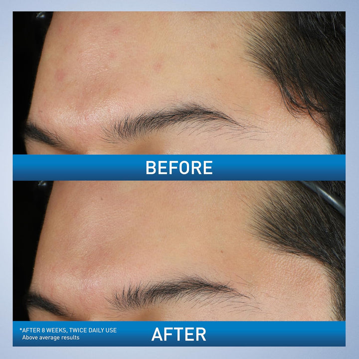 Acne Foaming Cream Wash, Gentle Face and Body Cleanser with Benzoyl Peroxide 10%, Hyaluronic Acid, and Niacinamide, 10% Benzoyl Peroxide Treatment Clears Pimples and Blackheads 5 Oz