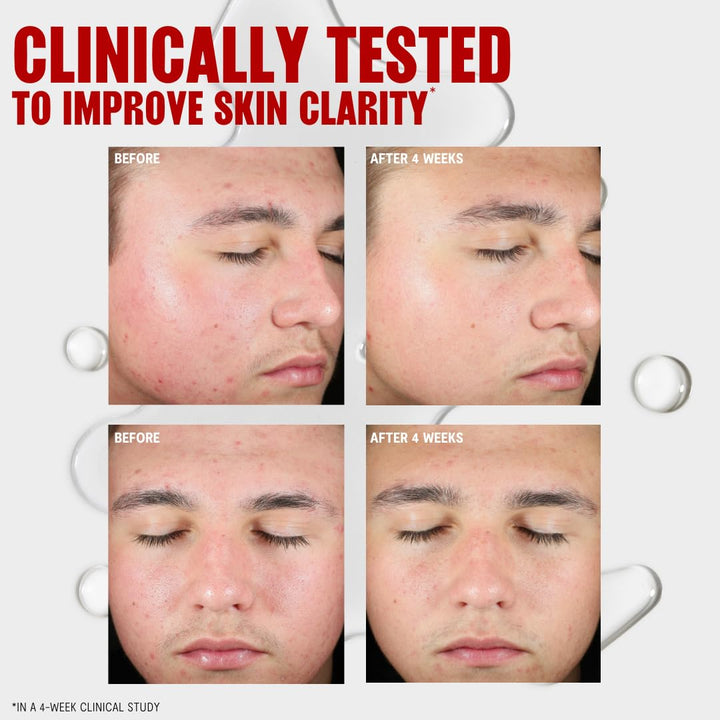 Blemish Clearing Salicylic Acid Toner, Acne Treatment Face Toner with 2% Salicylic Acid, Soothing and Non-Stripping Skin Care, 12 Fl Oz