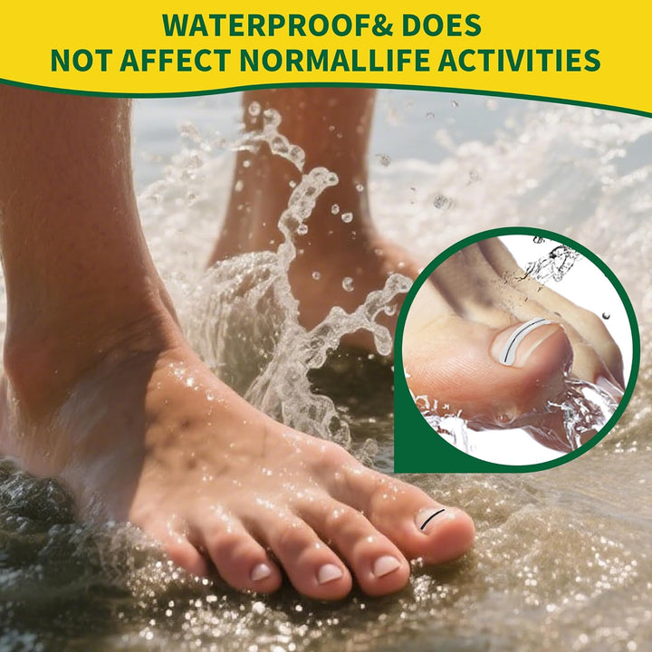 Large Size-Titanium Alloy Ingrown Toenail Treatment & Removal Kit for Quick Relief, Ingrown Toenail Removal Kit， Professional Ingrown Toenail Corrector, Ingrown Toenail Tools for Quick Relief, 10 Pcs