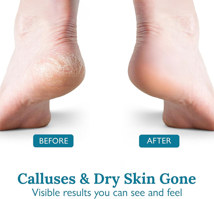 Foot Callus Remover Kit - 40% Urea Cream & Handmade Terra-Cotta Pumice Stone for Feet - Callus Remover for Feet with Shea Butter & Aloe Vera - Cracked Heel Treatment & Moisturizer