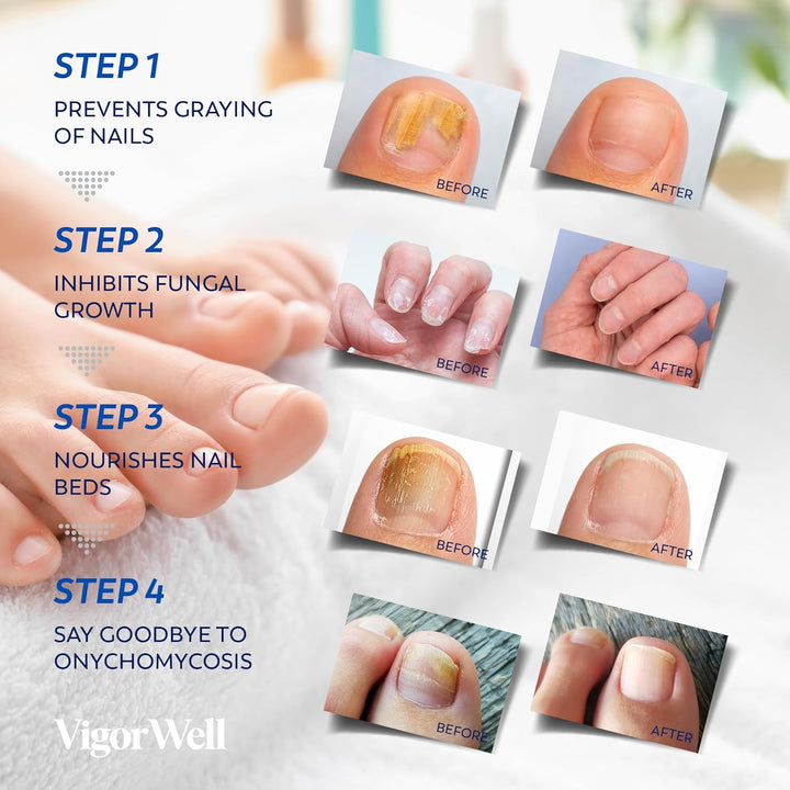 Toenail Fungus Treatment Extra Strength - (Medium) 32 Nighttime Hydrogel Patches for Overnight Toenail Repair - Visible Results in 8 Hours - Fungal Nail Patches for Toenail Fungus Relief