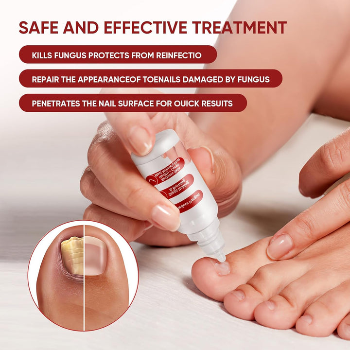 Toenail Treatment,Gentle Formula, Effectively Improves Nails for a More Beautiful Appearance