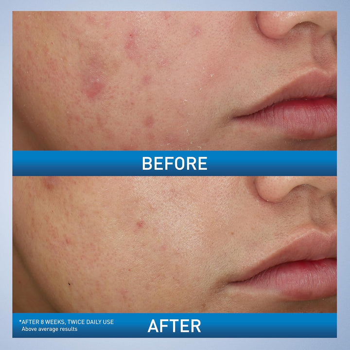 Acne Foaming Cream Wash, Gentle Face and Body Cleanser with Benzoyl Peroxide 10%, Hyaluronic Acid, and Niacinamide, 10% Benzoyl Peroxide Treatment Clears Pimples and Blackheads 5 Oz