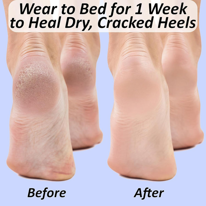 Moisturizing Socks for Cracked Heel Treatment: Socks for Cracked Heel Repair, Silicone Toeless Socks, Spa Gel Socks for Dry Cracked Feet Women, Lotion Moisture Pedicure Socks