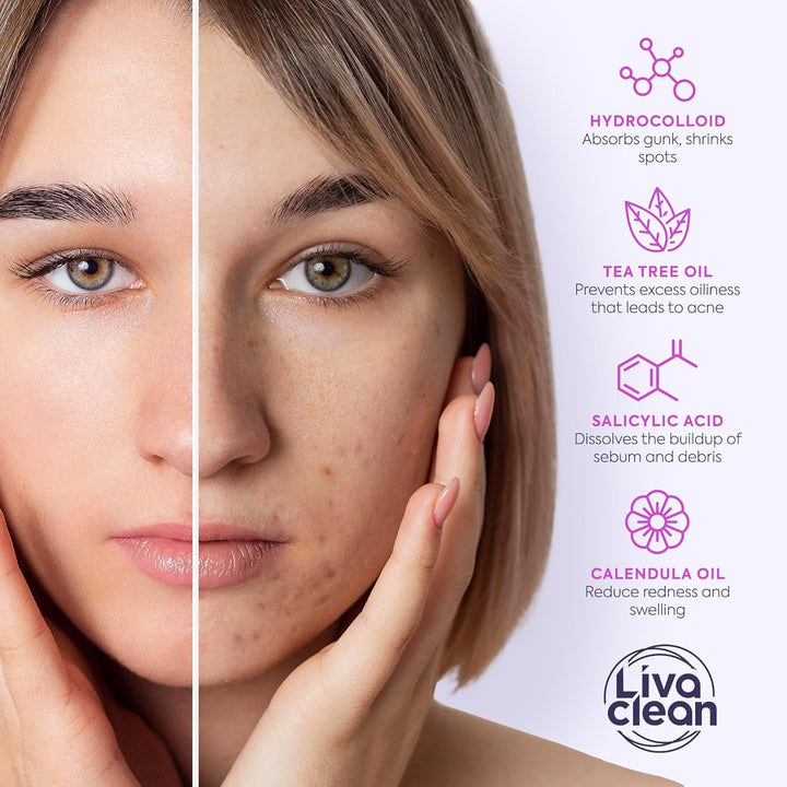 330 CT Pimple Patches for Face W/Salicylic Acid, Tea Tree Oil & Calendula Oil - Four Sizes - Pimple Patch, Hydrocolloid Patch, Acne Patches for Face