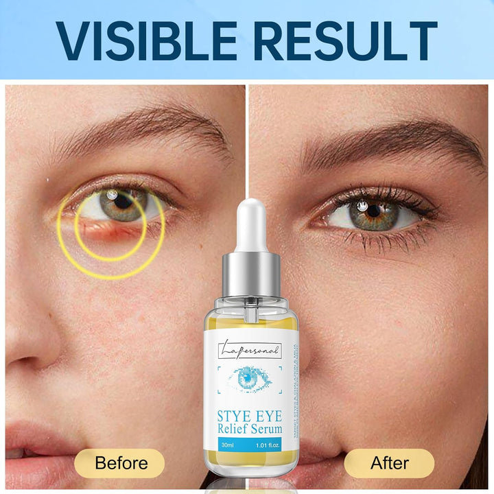 Stye Eye Treatment, Chalazion Remover, Eye Serum for Styes Chalazion and Blepharitis Treatment, with Avocado Oil, Sea Buckthorn Oil & Caffeine 1.01 Fl Oz/30 Ml