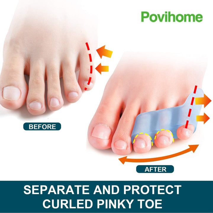 10 Pack Pinky Toe Separator and Protectors for Overlapping Toe, Curled Pinky Toes - Spacers for Morton'S Neuroma Pain Relief