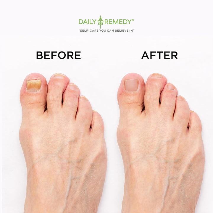 EXTRA STRENGTH Tea Tree Oil Foot Soak W/ Epsom Salt Made in USA Toenails，Athlete'S Foot，Itchy Feet，Stubborn Smelly Foot Odor，Pedicure Calluses & Soothes Sore Tired Achy Feet 16 Oz，Black