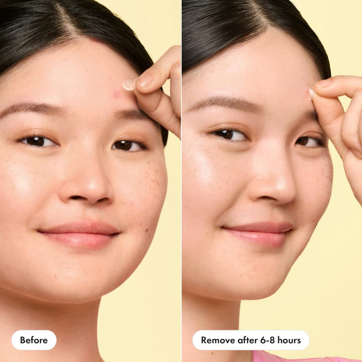 Mini Invisible+ Patches - X-Small Daytime Hydrocolloid Acne Pimple Patches for Covering Zits & Blemishes, Blends into Skin & Barely There (30 Count, 10Mm Patch)