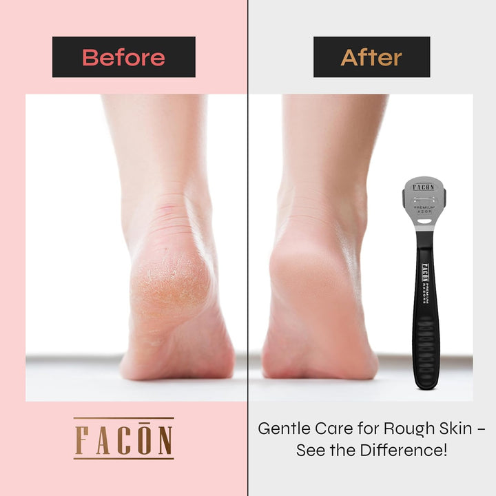 Facón Professional Callus Shaver Remover with 50 Blades, Pedicure Razor for Feet & Hands, Foot Razor for Callus Removal, Callus Blade Remover, Corn Shaver, Surgical Grade Premium Stainless Steel Tool
