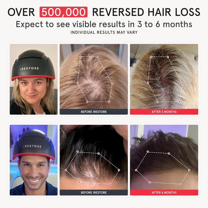 Elite - Laser Red Light Therapy for Hair Growth System - FDA Cleared Hair Loss, Hair Thinning & Alopecia Treatment for Men & Women - Laser Cap for Hair Regrowth Stimulates Denser Fuller Hair