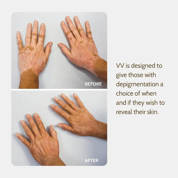 Vitiligo Vanquish Cosmetic Camouflage Kit by  Liquid Concealer, Long Lasting Natural Color Customization Eliminates Appearance of Skin Depigmentation for Women & Men - Cover Lasts for Days