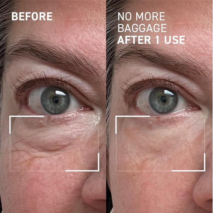 Needles No More, No More Baggage - Minimizes Under-Eye Bags, Puffiness & Dark Circles - 0.5 Oz