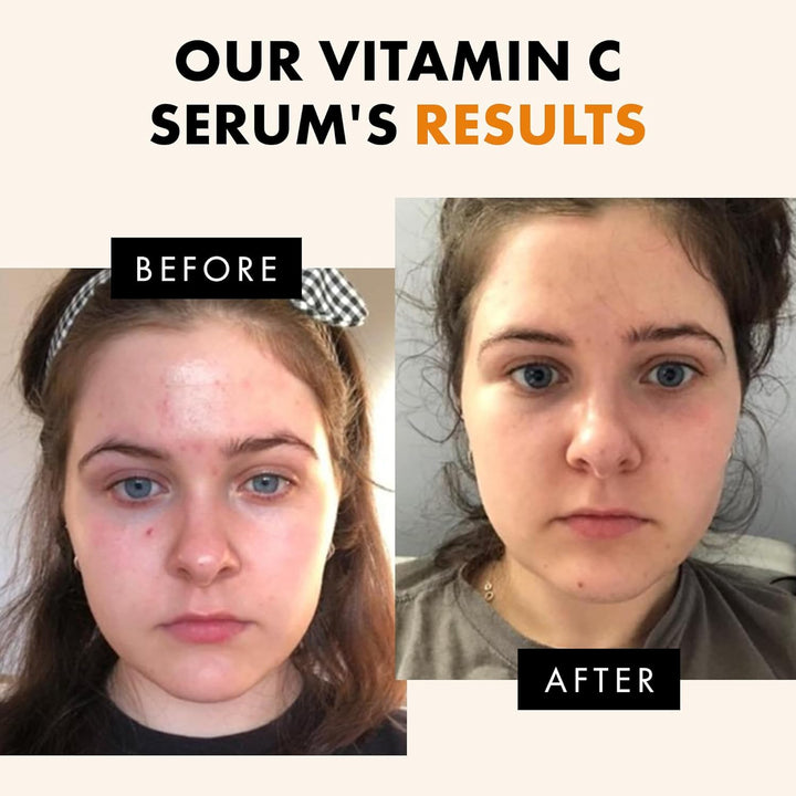 Vitamin C Face Serum - Skin Care for Dark Spots, Vitamin C Serum with Hyaluronic Acid, Ferulic Acid, & Vit E - anti Aging and Skin Brightening, Pure Vit C Facial Care - 30 Ml