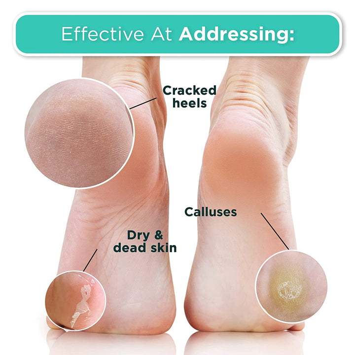 Foot Peel Mask - 2 Pack of Regular Size Skin Exfoliating Foot Masks for Dry, Cracked Feet, Callus, Dead Skin Remover for Baby Soft Feet, Original Scent