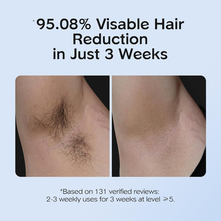 IPL Hair Removal with Ice Cooling Care Function for Women,Long-Lasting Results,999,999 Flashes Painless IPL Hair Remover, Hair Removal Device for Armpits Legs Arms Bikini Line