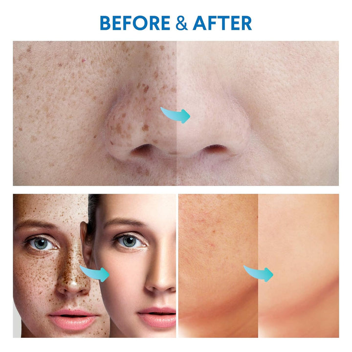 Razor Bump Stopper with Ingrown Hair Treatment: Razor Bumps Treatment for Men and Women, after Shave Solution for Ingrown Hairs and Razor Burns, Roll on Applicator- 3.38 Fl Oz