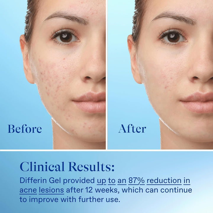 Acne Treatment Gel, 30 Day Supply, Retinoid Treatment for Face with 0.1% Adapalene, Gentle Skin Care for Acne Prone Sensitive Skin, 15G Tube (Packaging May Vary)