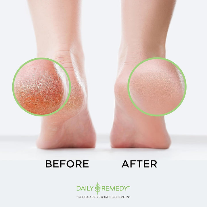 EXTRA STRENGTH Tea Tree Oil Foot Soak W/ Epsom Salt Made in USA Toenails，Athlete'S Foot，Itchy Feet，Stubborn Smelly Foot Odor，Pedicure Calluses & Soothes Sore Tired Achy Feet 16 Oz，Black