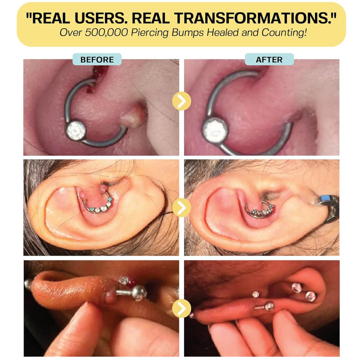 Keloid Bump Removal Gel | Natural Piercing Bump Treatment & Keloid Scar Gel | Keloid Scar Removal for All Scars, Keloids & Piercing Bumps | Soothing Piercing Aftercare | 2 Oz