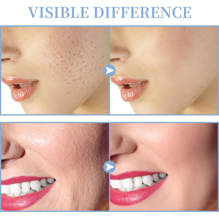 High Frequency Facial Machine -  Portable Handheld High Frequency Facial Skin Wand Machine with 4 Different Tubes