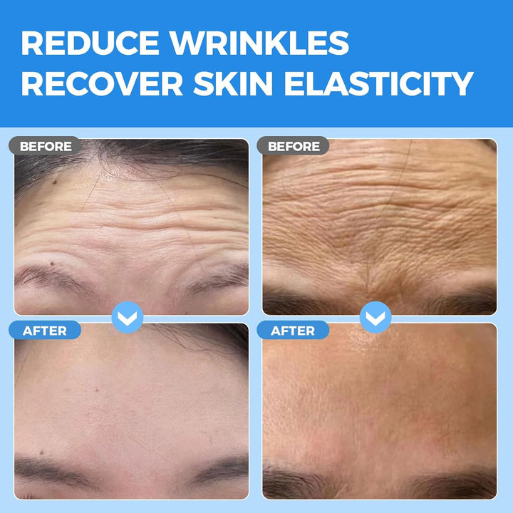 Forehead Wrinkle Patches Overnight 20 Pcs with Collagen, anti Wrinkle Patches, Forehead Wrinkles Beauty Treatment