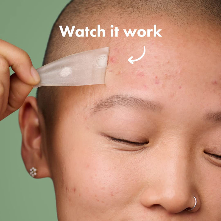 Surface Large Pimple Patches for Face from , Acne Spot for Body, Cheek, Forehead, and Chin, Pimple Stickers, Hydrocolloid Covers, Vegan-Friendly, 10 Count