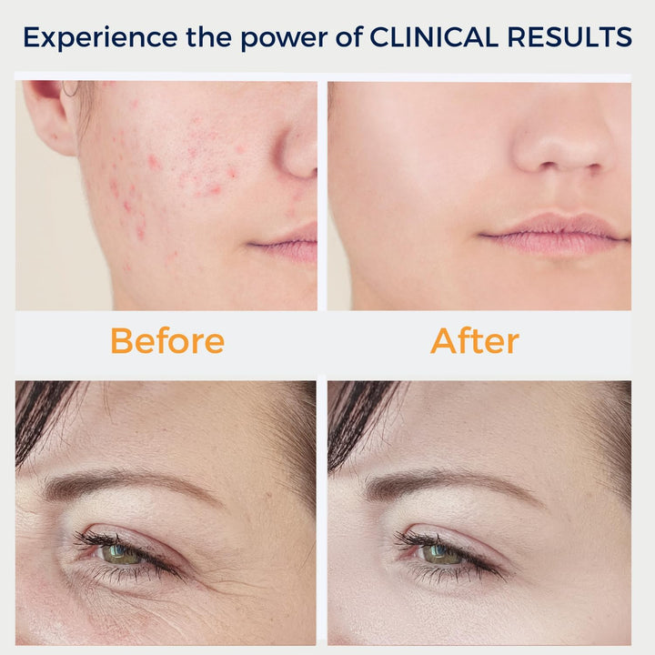 Dermatiprem High Frequency Wand