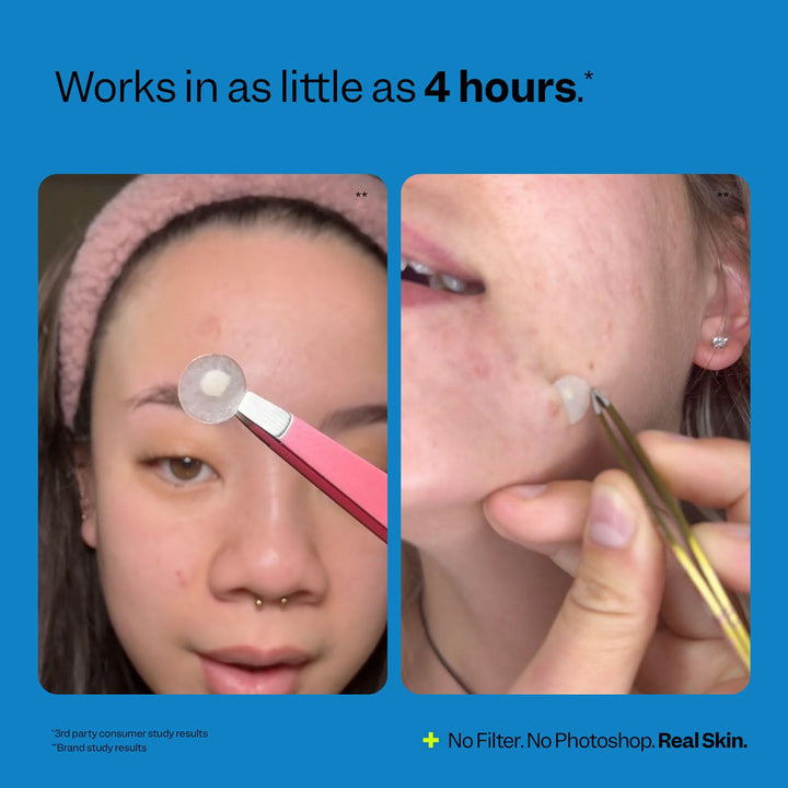 - Acne Spot Dots (30 Ct) - Hydrocolloid Pimple Patches for Face - Absorb Gunk, Protect Picking & Support Healing - 3 Sizes (7, 10, & 12Mm) - Vegan, Cruelty Free, Korean Skin Care & Beauty