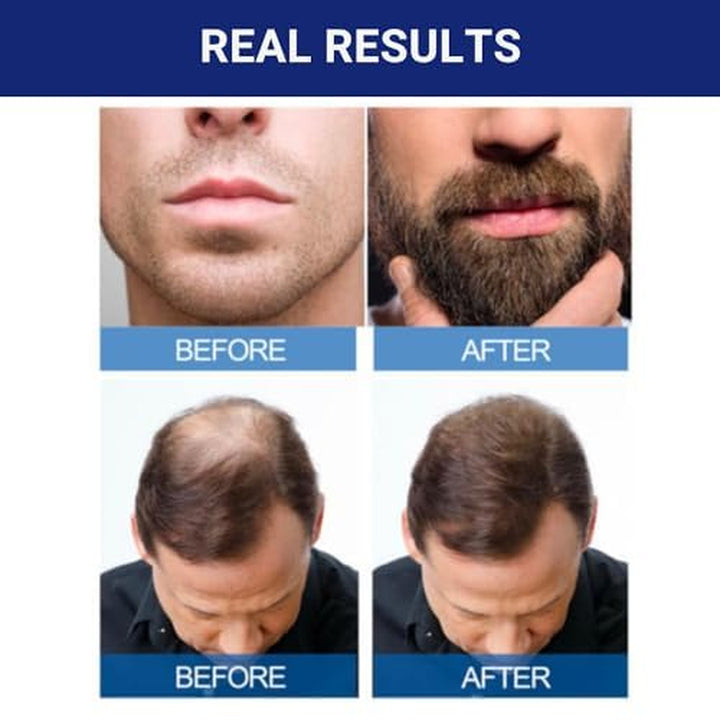 Signature Minoxidil for Men 5% Extra Strength Hair Regrowth for Men Vqzjbi, 1 Month Supply