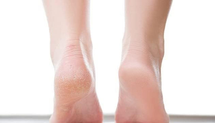 Corn & Callus Trimmer - Instant Relief from Corns & Calluses | Removes Dry, Hard & Cracked Skin | Home Pedicure Treatment for Footcare