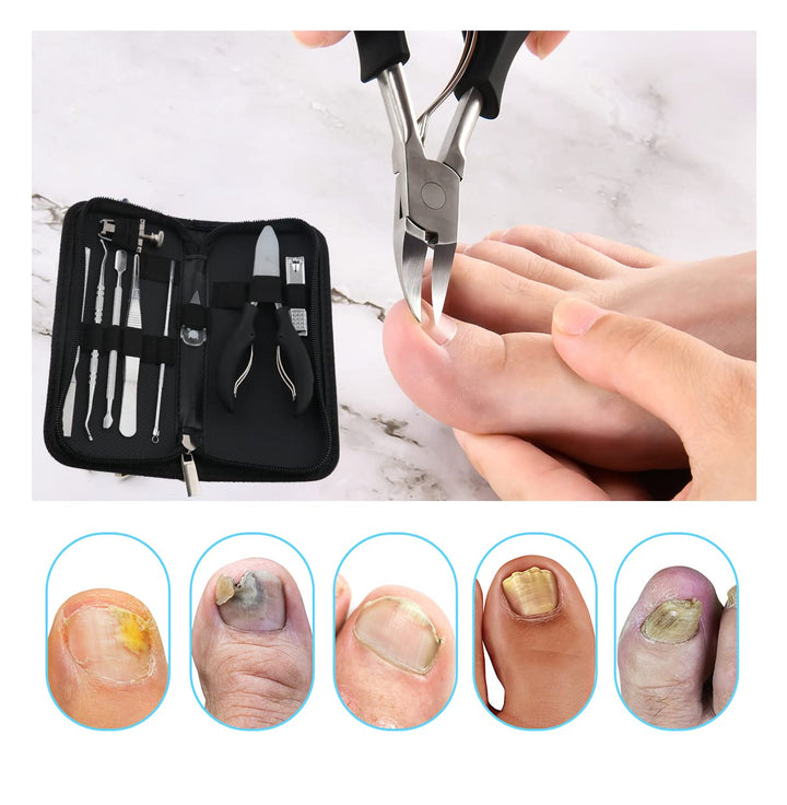 10Pcs/Set Ingrown Toenail Tools Kit, Nail Treatment Foot Tool,Ingrown Toenail Removal Correction Clippers, Surgery Grade Nail File Lifter, Professional Pedicure Tool