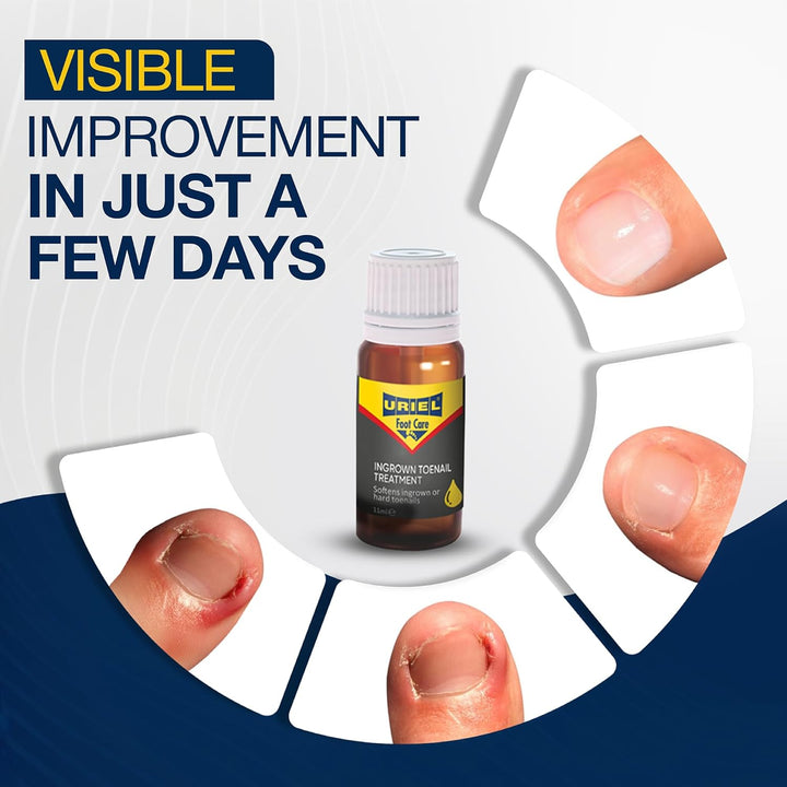 UPGRADED Ingrown Toenail Treatment, Ingrown Toenail Removal Kit, Ingrown Toenail Corrector, Ingrown Nail Kit Ingrown Toenail Tool 11 Ml