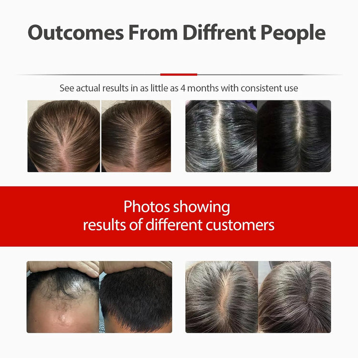 2026 Upgrade Laser Cap, Red Light Therapy for Hair Growth