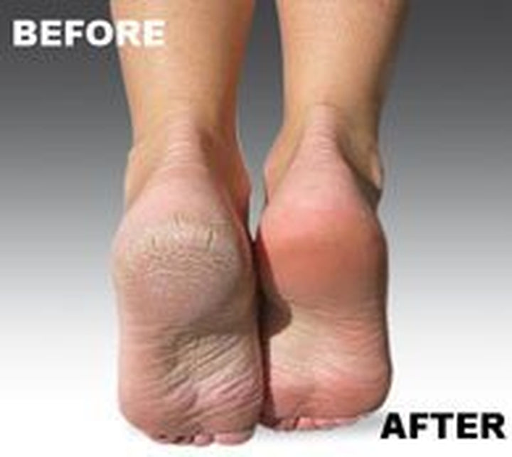 Genuine  Micro-Pedi Refill Rollers (Extra Coarse) by