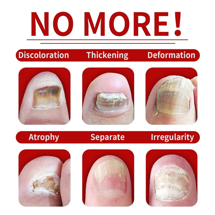 Ginger Nail Treatment, Ginger Cuticle Care Oil for Nails (2 PCS)