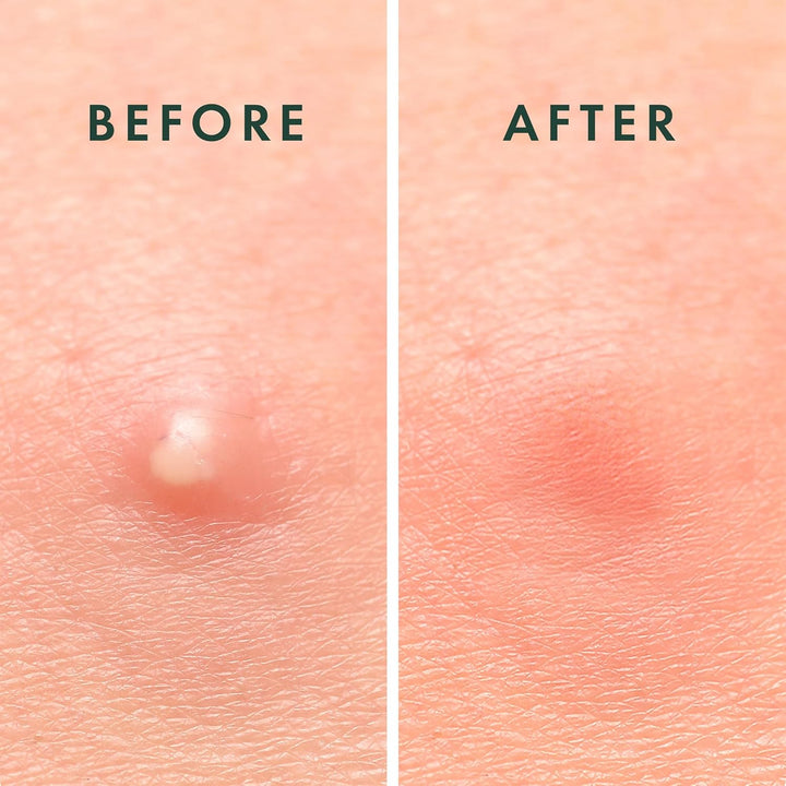 Pimple Patches, Miracle Invisible Spot Cover - Hydrocolloid Acne Patch, Treatment for Breakouts, Absorbs Zits & Blemish, Korean Skin Care, 2 Sizes (96 Count)