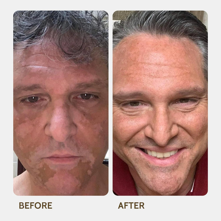 Vitiligo Vanquish Cosmetic Camouflage Kit by  Liquid Concealer, Long Lasting Natural Color Customization Eliminates Appearance of Skin Depigmentation for Women & Men - Cover Lasts for Days