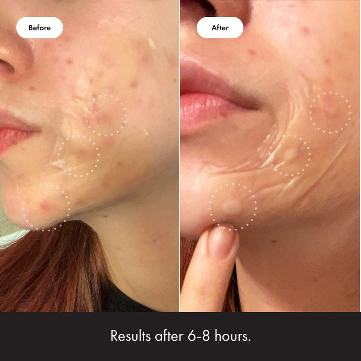 Surface Large Pimple Patches for Face from , Acne Spot for Body, Cheek, Forehead, and Chin, Pimple Stickers, Hydrocolloid Covers, Vegan-Friendly, 10 Count